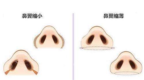 鼻翼缩小.jpg